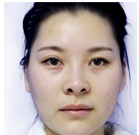 美萊案例袁婷對比圖后