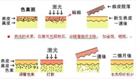 昆明華美美萊美容醫(yī)院俞滿昌激光祛斑