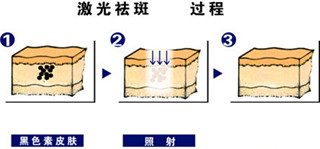 麗江日曬斑怎么祛除價格多少