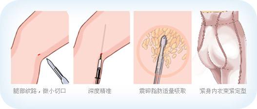 吸脂瘦腿手術(shù)后多長時(shí)間可以恢復(fù)呢