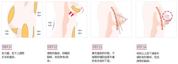 廣州做自體脂肪隆胸術(shù)后會(huì)不會(huì)出現(xiàn)胸部下垂的現(xiàn)象呢