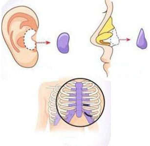 自體軟骨隆鼻的危害有哪些