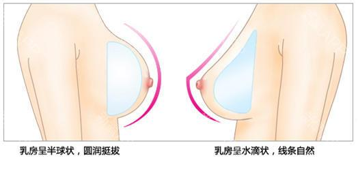 假體隆胸對(duì)身體有壞處嗎