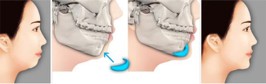 衡陽(yáng)假體墊下巴術(shù)后會(huì)不會(huì)松弛