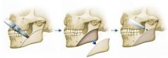 福州下頜角整形手術(shù)是怎樣的