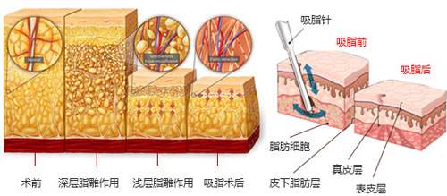 沈陽做大腿吸脂對身體會(huì)不會(huì)有影響