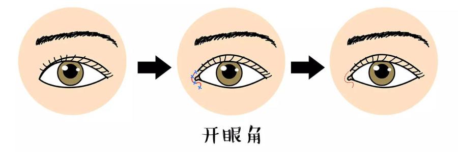 天津做開(kāi)眼角失敗了怎么辦