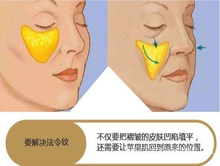 脂肪填充法令紋能維持多少時間？