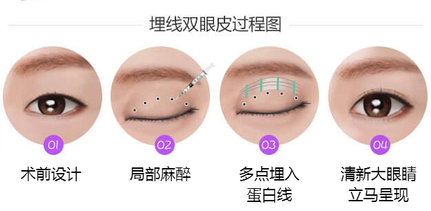 埋線(xiàn)雙眼皮的效果可以維持多少年呢