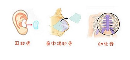 自體軟骨隆鼻的潛在風(fēng)險