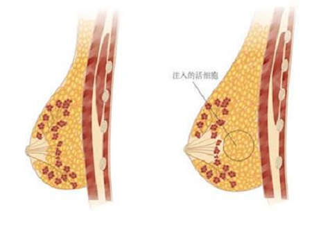 做自體脂肪豐胸手術會不會出現(xiàn)硬塊的現(xiàn)象