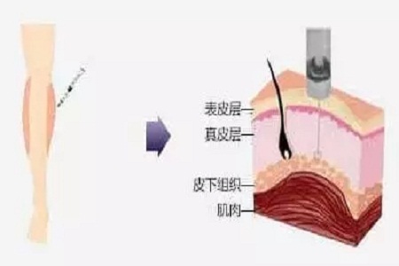 重慶做大腿抽脂手術(shù)后護理措施有哪些