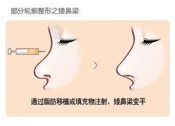 武漢注射玻尿酸隆鼻多少錢？