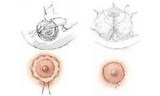 乳暈再造術(shù)價(jià)格是多少？