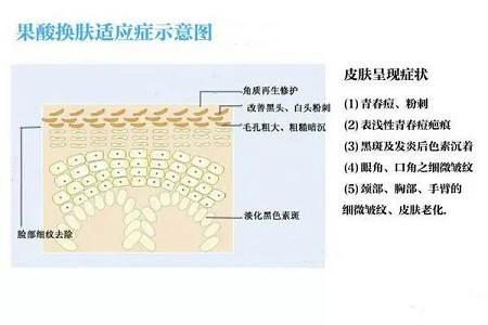 擠痘竟然被送進ICU！你的痘痘還好嗎？