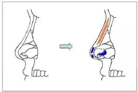 擔心鼻整形假體透光、發(fā)紅、移位？了解下自體軟骨