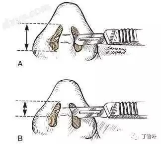 隆鼻手術(shù)切口在哪里？才能自然不留疤
