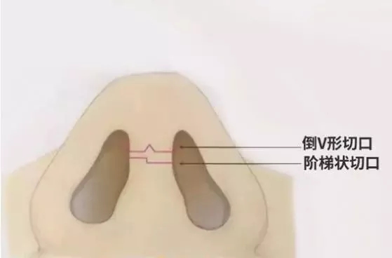 隆鼻手術(shù)切口在哪里？才能自然不留疤