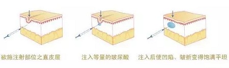 法令紋、川字紋