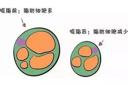 關(guān)于吸脂那些不能說的秘密，今天要在這里一次說完！