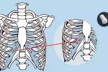 糾結(jié)！鼻頭太圓想塑形是用肋軟骨還是耳軟骨好？