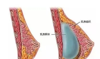 自體脂肪or假體隆胸，我到底應(yīng)該怎么選？