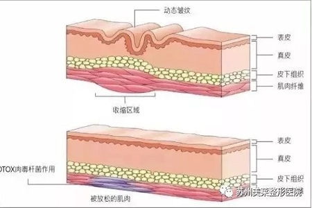 你無法用玻尿酸除掉所有皺紋！