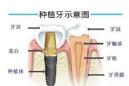 揭秘牙齒矯正的全過程?。?！