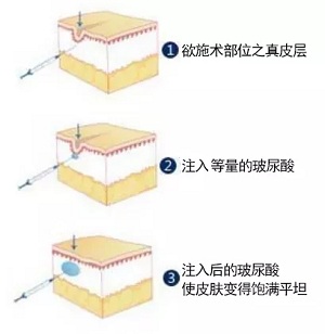 用玻尿酸治療鼻唇溝，一定要注意這種情況！