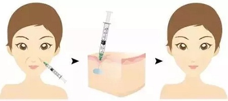 用玻尿酸治療鼻唇溝，一定要注意這種情況！