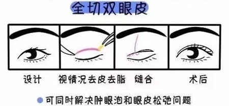 美眼張誠坐診美萊，淺談為什么你的眼睛不夠美？