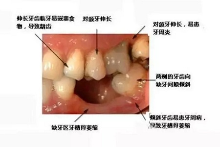 牙齒缺失時(shí)，選烤瓷牙還是那種？