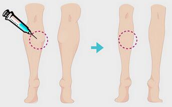 鄭州瘦腿多少錢一針