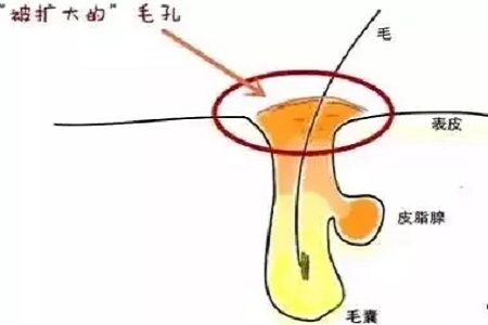 毛孔粗大應(yīng)該要怎么辦