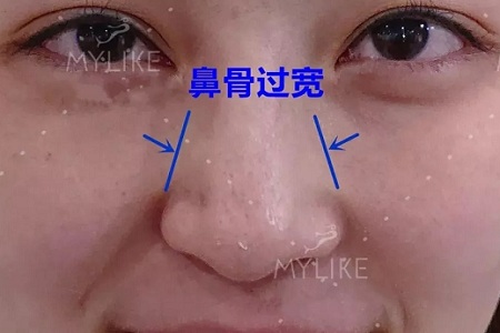 側(cè)面看鼻梁不矮,正面看鼻子卻很塌是什么原因？