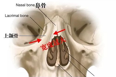 側(cè)面看鼻梁不矮,正面看鼻子卻很塌是什么原因？