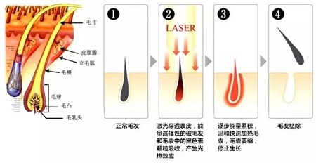 激光脫毛