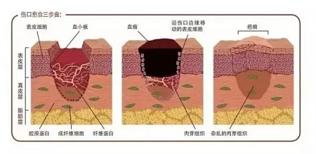 疤痕