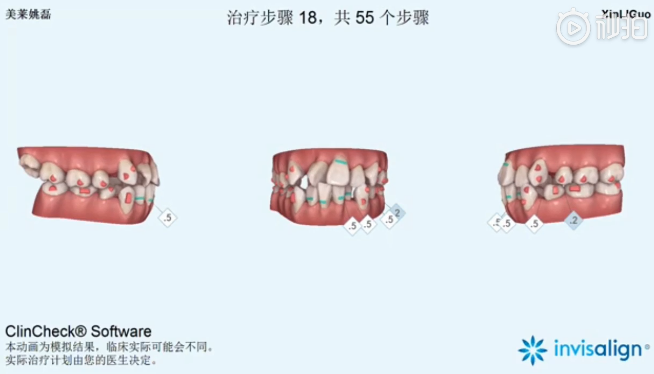 南京美萊口腔全景側(cè)位片，拍照取模，動畫方案設(shè)計