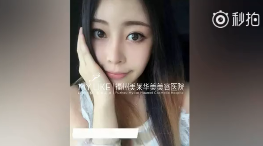 福州美萊鼻子幾毫米的改變，自信百倍的蛻變