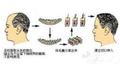 鄭州美萊整形醫(yī)院植發(fā)做的好嗎