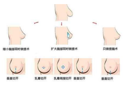 乳房下垂矯正術(shù)