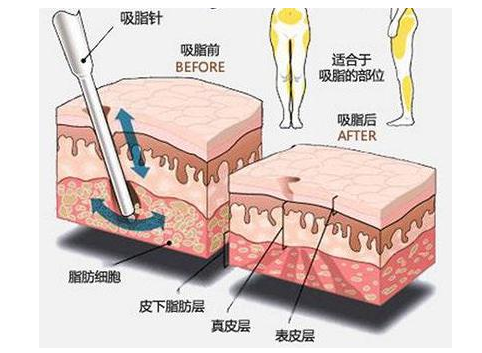 鄭州美萊吸脂瘦身等于減重？