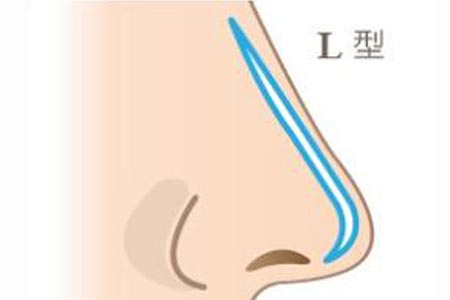 進(jìn)口硅膠假體隆鼻手術(shù)多少錢