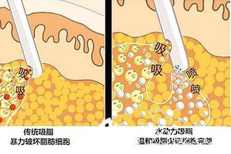 腹部吸脂減肥會(huì)反彈嗎