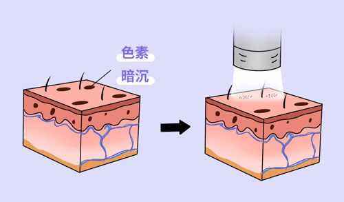 想要嫩膚，應(yīng)該選擇做光電還是水光